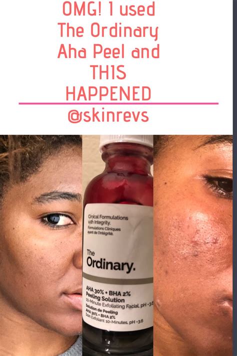 Salicylic acid is the most benefits of 30% aha and 2% bha peeling solution. OMG! The Ordinary AHA Peeling Solution Did This To Me ...