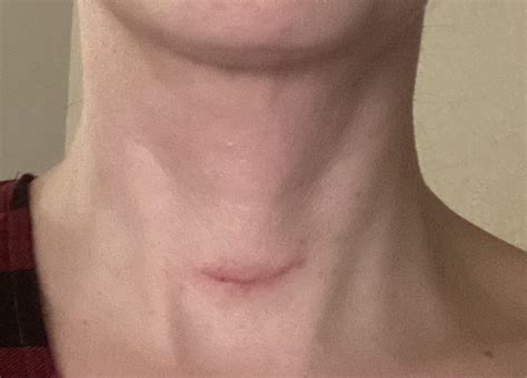 Months After Surgery My Scar Looks Big And Red Any Suggestions To