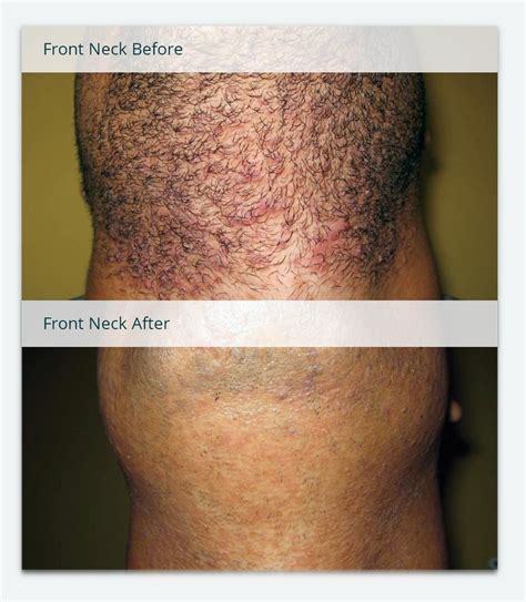 Before And After Photos Of Laser Hair Removal Milan Laser Ingrown Hair Removal Ingrown Hairs
