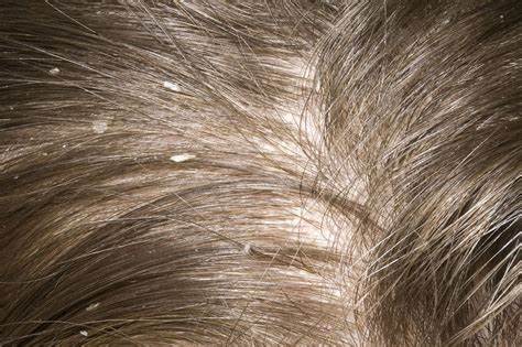 Side effects Of Dandruff, Its Types, Causes, And How To Treat It