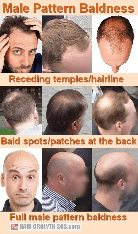 Why The Pattern In Male Pattern Baldness Develops