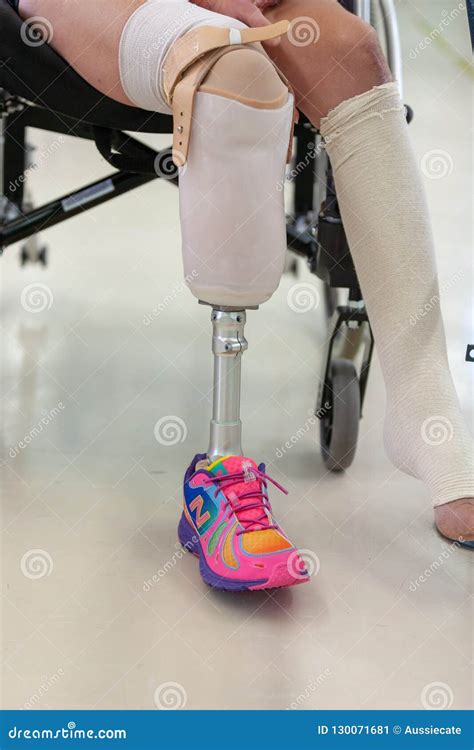 Young Woman With Prosthetic Leg New Amputee Editorial Photo Image