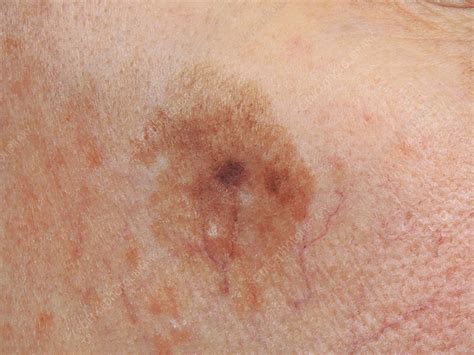 Lentigo Maligna Melanoma Stock Image C0461646 Science Photo Library