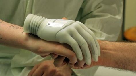 Bionic Hand For Elective Amputation Patient Bbc News