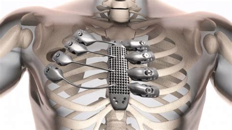 Cancer Patient Receives Worlds First 3d Printed Rib Cage Implant The