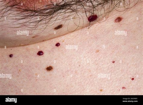 Close Up Of Benign Naevi Moles And Campbell De Morgan Spots Cherry