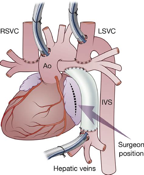 Partition Of Common Atrioventricular Valve In A Patient With