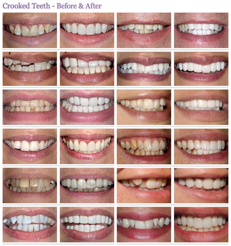 Our practice is conveniently located in suite 120 at 1805 highway 42. Crooked or Crowding Teeth Treatment before & after photos ...
