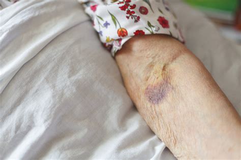 Seniors Arm With Bruise Stock Photo Download Image Now Bruise