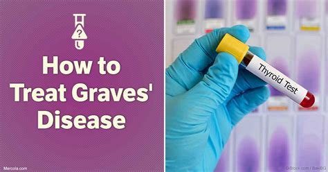 How To Treat Graves Disease