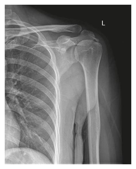 Anteroposterior X Rays Of A 45 Year Old Female Patient With Shoulder