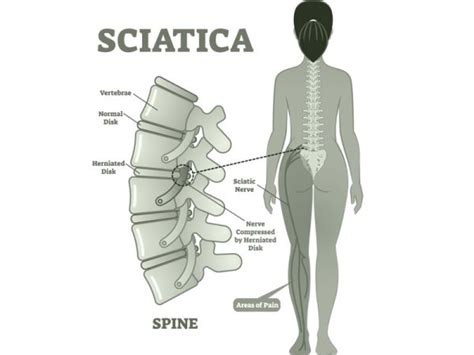 About Sciatica And Sciatic Nerve Pain Best Health Physio