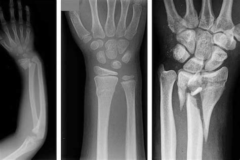 Acute Carpal Tunnel Syndrome In Inpatients With Operative Distal Radius