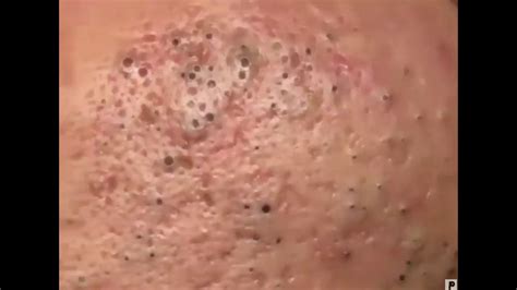NẶn MỤn 7 NĂm Ở MẶt Removing 7 Year Old Blackheads On Face Youtube