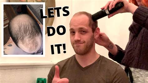Going Bald At 30 Shaving My Head Bald After 10 Years Of Balding