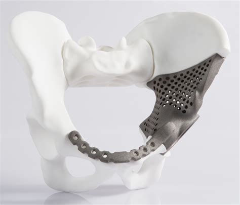 The Titanium Implant Has A Large Number Of Cavities These Weight