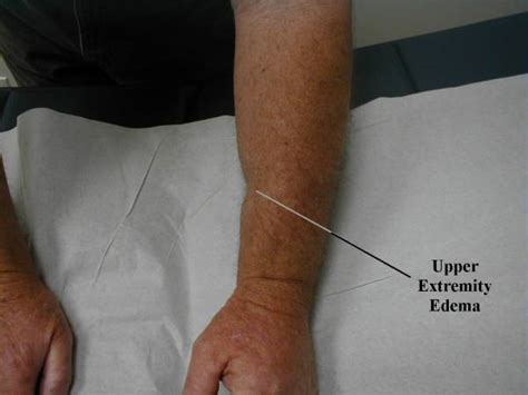 Upper Extremity Prohealthsys