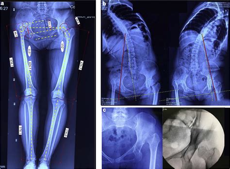 Figure 1 From Direct Anterior Approach Total Hip Arthroplasty For Crowe