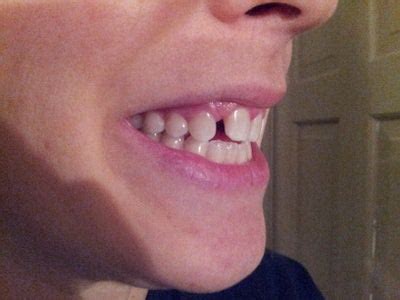 In some cases, it is possible to solve the problem of the gap teeth through veneers. Can I fix this gap without braces? (photo) Dentist Answers ...