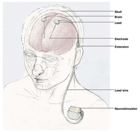 Illustration Of A Deep Brain Stimulator Download Scientific Diagram