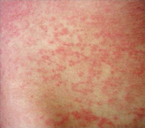 Mononucleosis Rash Common Viral Rashes Include Mononucleosis Chickenpox And Shingles