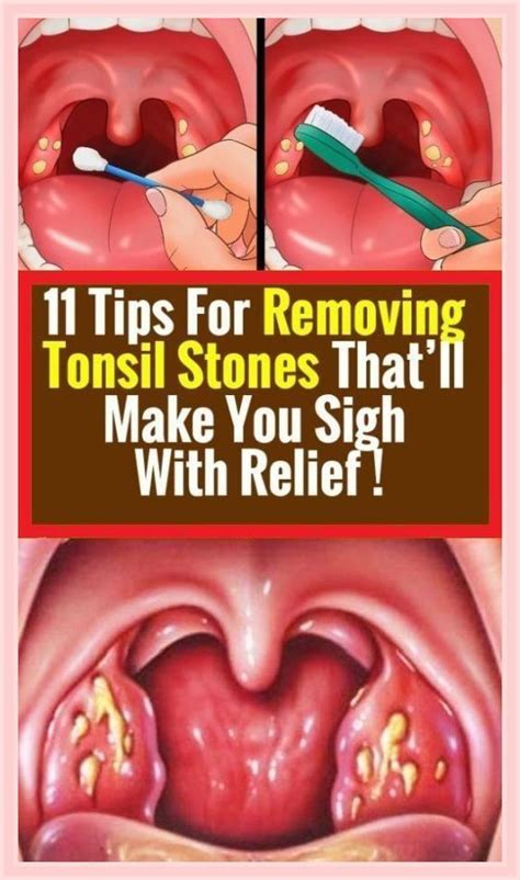 4 Effective Ways To Remove Tonsil Stones Without Surgery Artofit