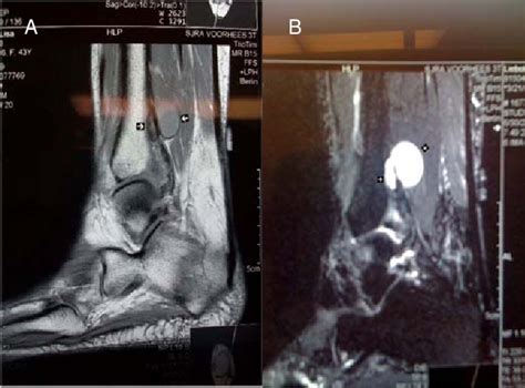 Figure From Ganglion Cyst Of The Distal Tibia A Case Report