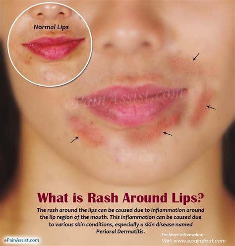 Best Of How To Get Rid Of Heat Rash Around Lips And View In 2020 Dry Itchy Skin Perioral