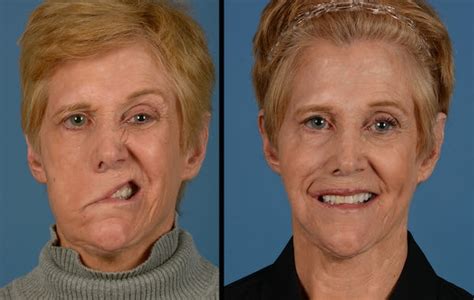 Facial Paralysis Bells Palsy Symptoms Causes And Treatment Santripty