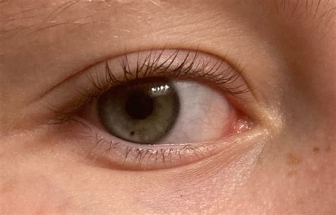 My Sister Has A Freckle In Her Eye Rmildlyinteresting