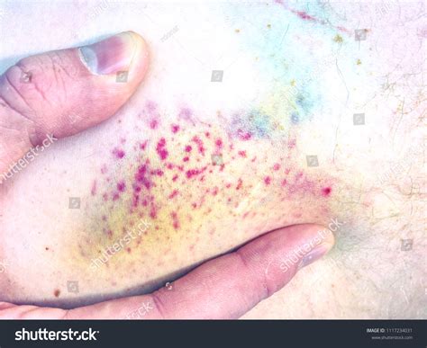 Purple Bruise On Affected Skin Close Stock Photo 1117234031 Shutterstock