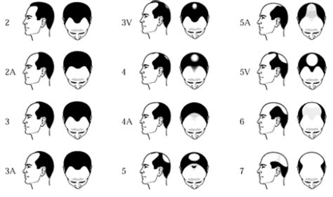 American Hair Loss Association Men S Hair Loss The Norwood Scale