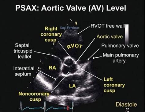 Aortic Valve Level Tee Cardiac Sonography Diagnostic Medical