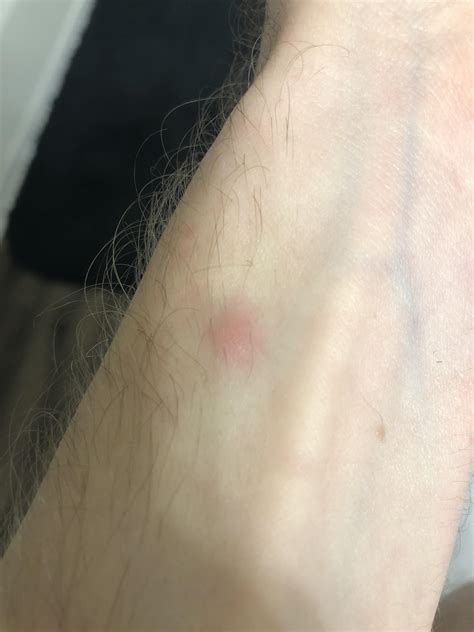 I Noticed A Small Red Bump On My Arm After Wearing My Apple Watch All
