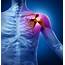 The Best Evidence For Rotator Cuff Related Shoulder Pain  IMove