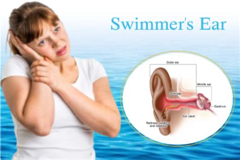 Swimmers Ear Infection Otitis Externa Diagnosis And Treatment