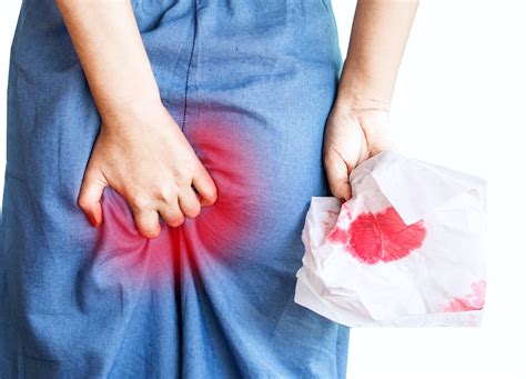 Laser Haemorrhoid Piles Treatment Diagnosis Treatment And Prevention