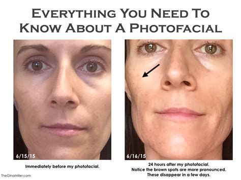 Ipl Photofacial Before And After Photos Forever Young