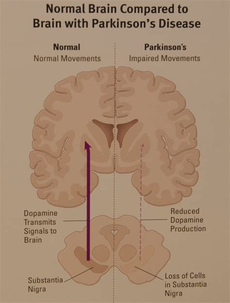 Parkinsons Disease Brain Diagram Minimalistisches Interieur