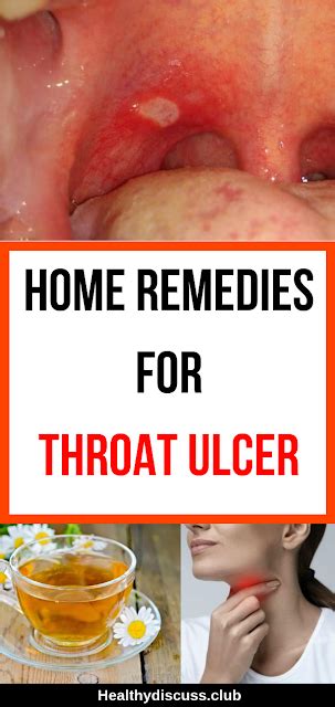 Home Remedies For Throat Ulcer Throat Sorethroat Ulcers