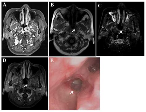 Clinical And Imaging Characteristics Of 53 Ulcers Of Post‑radiation