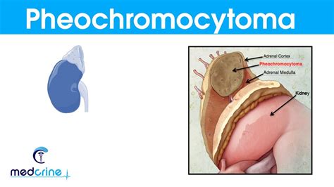 Pheochromocytoma Causespathophysiologysymptoms And Treatment Youtube