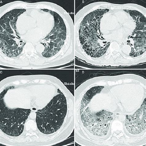 Chest High Resolution Computed Tomography Of Patients With Idiopathic