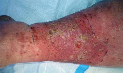 Streptococcal Infections As Related To Cellulitis Pictures