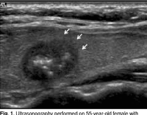 Figure 3 From Ultrasonographic Findings Of Medullary Thyroid Carcinoma