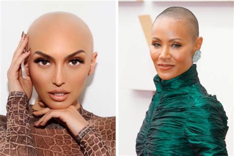 12 Celebrities With Alopecia And Hair Loss Wimpole Clinic