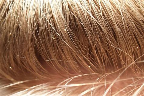 How To Check Your Own Hair For Lice Home Interior Design