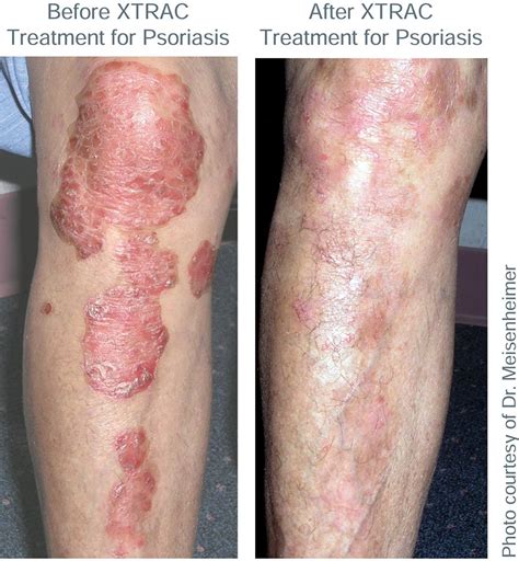 Xtrac Psoriasis Laser Advanced Dermatology And Cosmetic Surgery Center