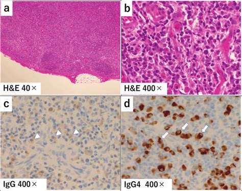 Histopathological Findings Of The Left Inguinal Lymph Node Biopsy