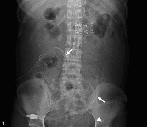 Plain Abdominal Radiograph Revealed Multiple Eggshell Calcifications